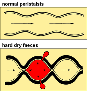 diverticula