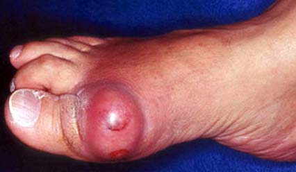gouty toe
