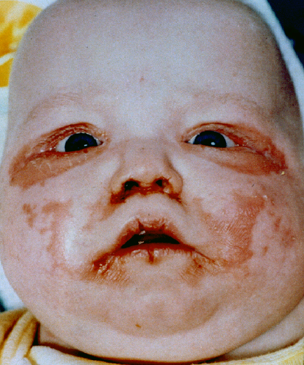 biotindefbaby