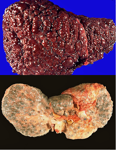 cirrhosisgross