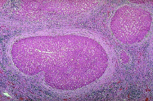 cirrhosisHIstol