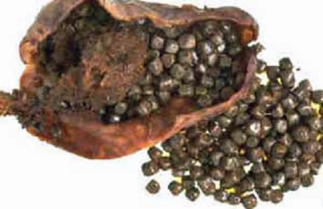 gallstones