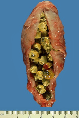 gallstones2