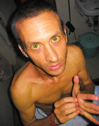 jaundice