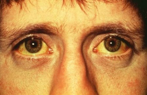 jaundice eyes